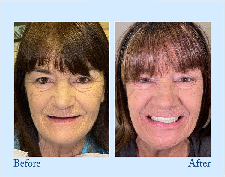 HZA | Advanced Custom Full Denture Set