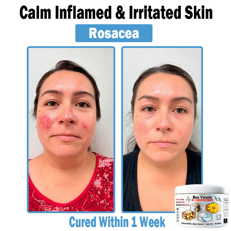 Bee Venom - Multi-Symptom Skin Treatment Cream