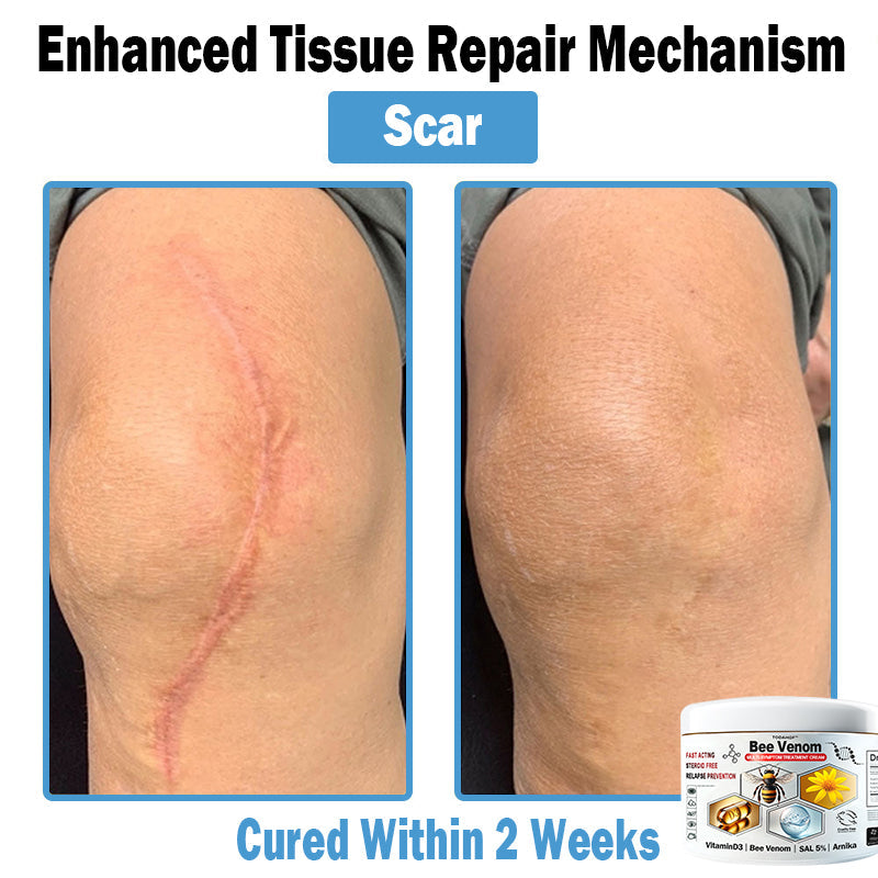 Bee Venom - Multi-Symptom Skin Treatment Cream