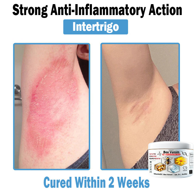 Bee Venom - Multi-Symptom Skin Treatment Cream