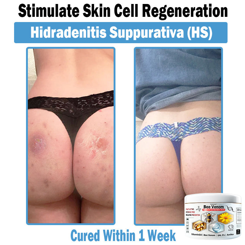 Bee Venom - Multi-Symptom Skin Treatment Cream